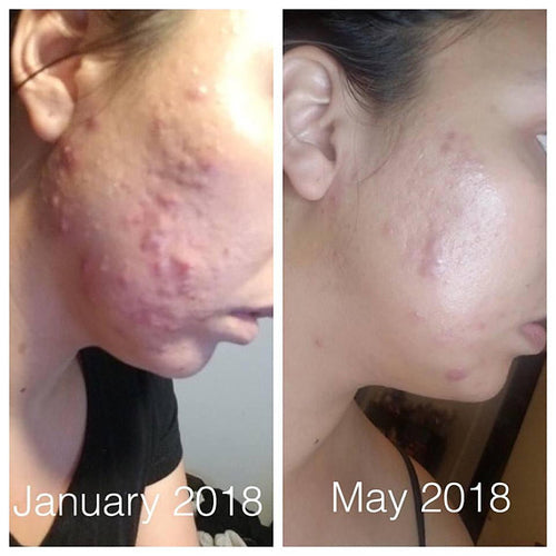 Súper combatiente  Tratamiento orgánico para el acné.Acne: Acné.