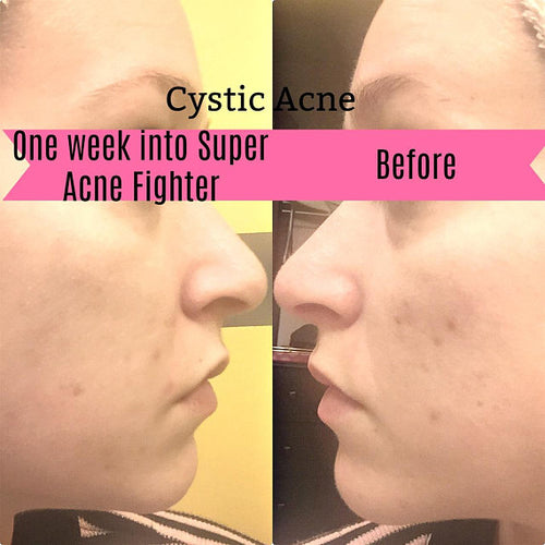 Súper combatiente  Tratamiento orgánico para el acné.Acne: Acné.